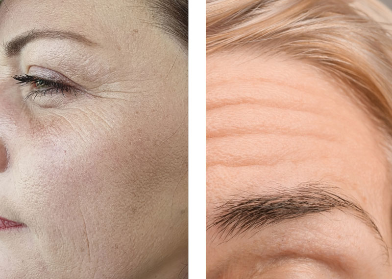 faltenbehandlung mit einem muskelrelaxans augen augenklinik sulzbach