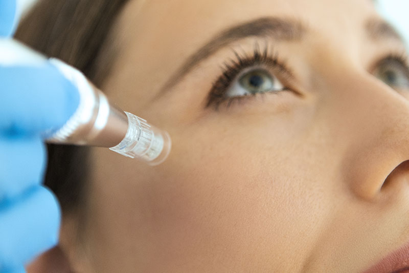 aesthetische medizin augenklinik sulzbach Dermapen