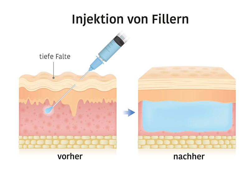 Injektion von Fillern - Aesthetische Medizin Augenklinik Sulzbach