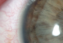Fotografie Iriswurzel mit massiver Pigmentüberfrachtung