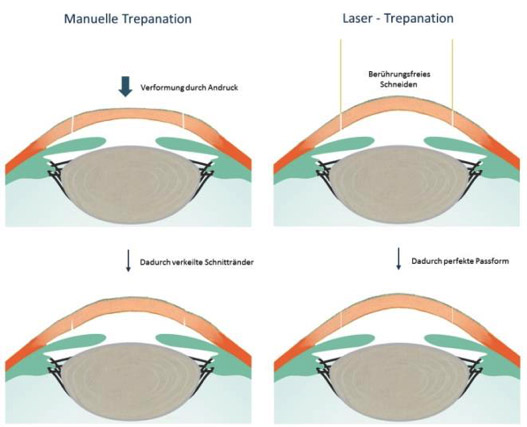 Trepanation manuell vs Laser