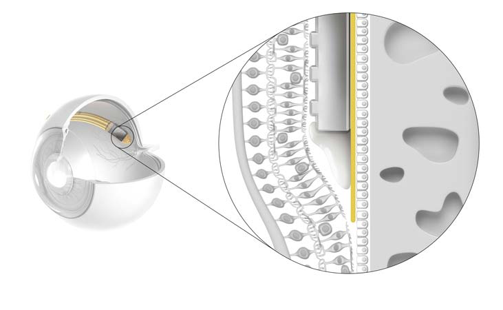 Retina Implant Alpha AMS mit Retina