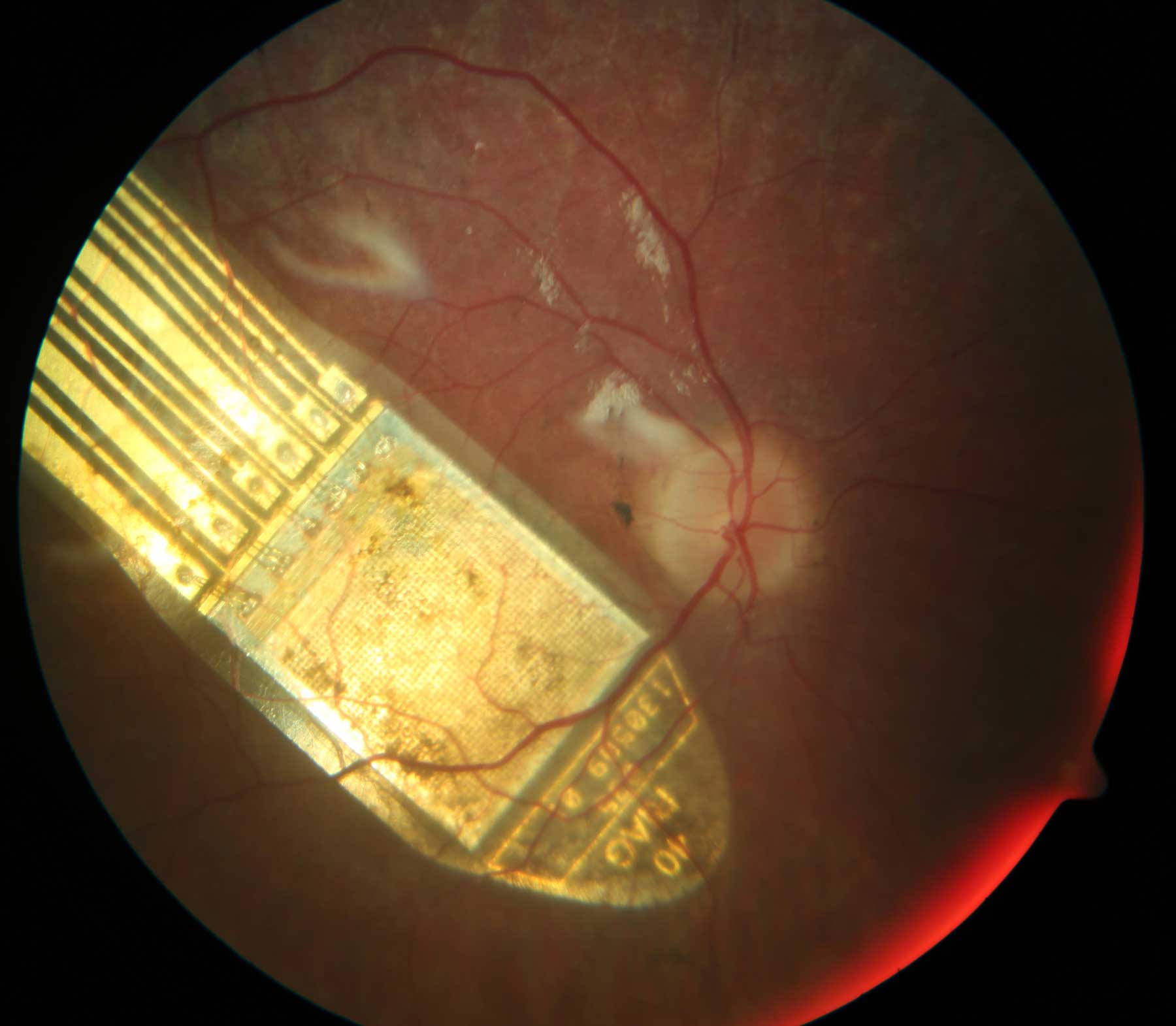 Retina Implant Alpha AMS im Auge