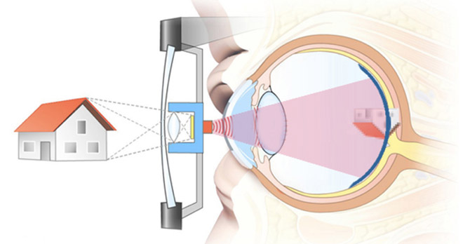 Weitwinkel-Retina-Implantat